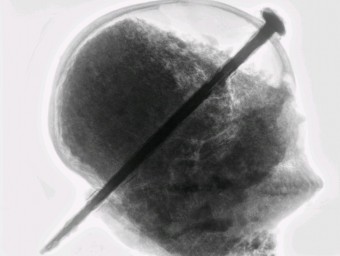 El crani radiografiat en la primera fase d'estudi MAC-ULLASTRET – UNITAT DE DIAGNÒSTIC PER LA IMATGE DE L'HOSPITAL DE PALAMÓS